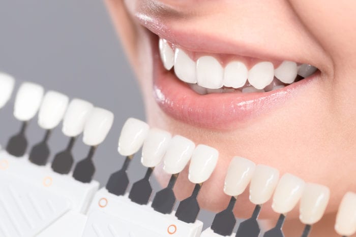 Teeth whitening in Palmdale California